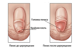 Фимоз
