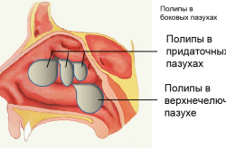 Полипы в носу