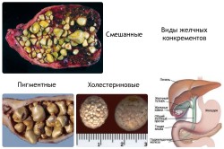 Виды желчных камней