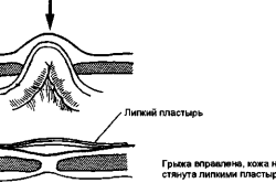 Заклеивание грыжи специальным пластырем
