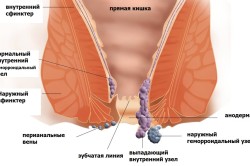 Схема геморроя