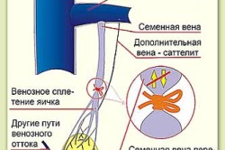 Метод Иваниссевича при варикоцеле