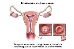 Конизация шейки матки