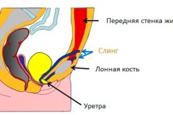 Схема установка слинга