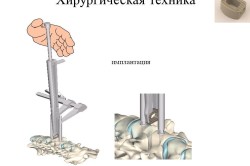 Хирургическая техника для имплантации дисков