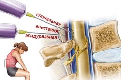 Спинальная анестезия