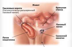 Строение паховой грыжи