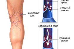 Венозная тромбоэмболия ног