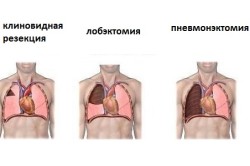 Виды операций на легких