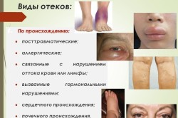 Виды отеков по происхождению Виды отеков по происхождению