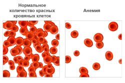 Анемия в результате геморрагического васкулита Анемия в результате геморрагического васкулита