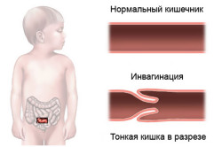 Инвагинация кишечника