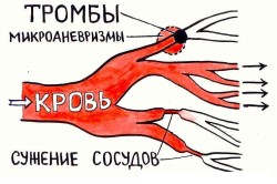 Образование тромбов