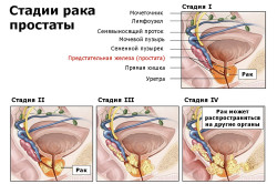 Стадии рака простаты