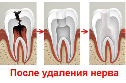 Удаление нерва из зуба