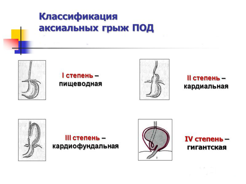 Степени нарастания аксиального выпячивания