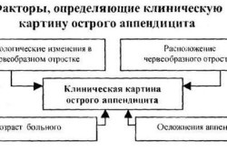 Факторы острого аппендицита