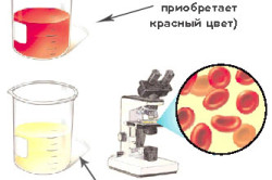 Гематурия