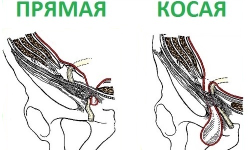 При косой грыже содержимое выпячивания находится внутри семенного канатика, а воротами становится внутреннее паховое кольцо