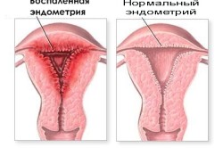 Эндометрит - одна из причин повышения лейкоцитов в мазке