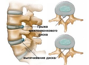 Межпозвонковая грыжа диска