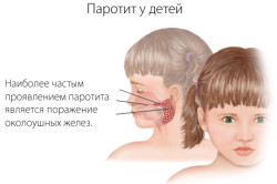Схема паротита Схема паротита