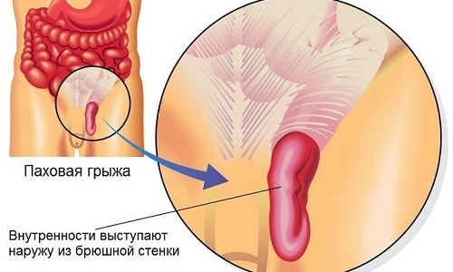 Паховая грыжа - это распространенное детское заболевание, при котором содержимое брюшной полости выпячивается через паховый канал