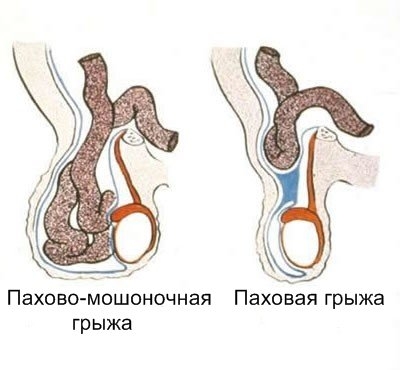 Наглядный пример отличия паховых грыж