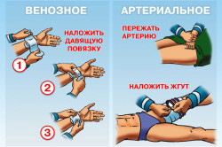 Методы остановки венозного и артериального кровотечений