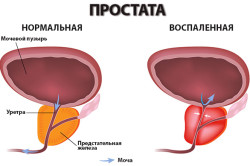 Простатит - причина крови в моче у мужчин