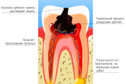 Кариес и его осложнения