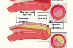 Закупорка сосудов