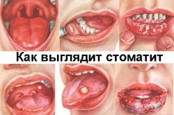 Стоматит