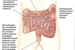 Механизм возникновения запора