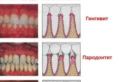 Виды заболевания десен