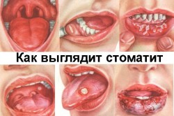 Виды стоматита