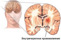 Внутричерепное кровоизлияние 